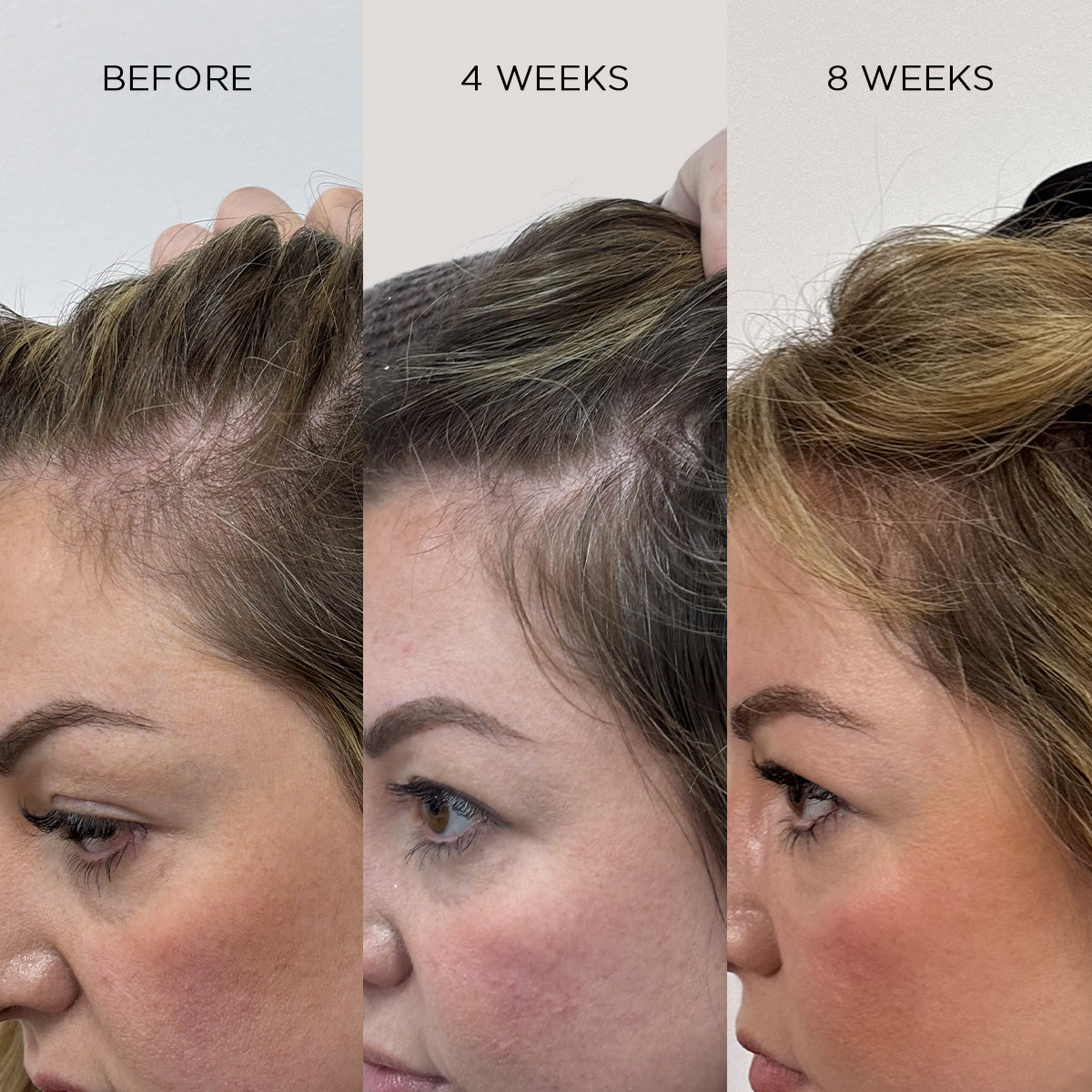 NANOGEN HAIR GROWTH FACTOR SERUM - 90 Day Treatment - Nanogen